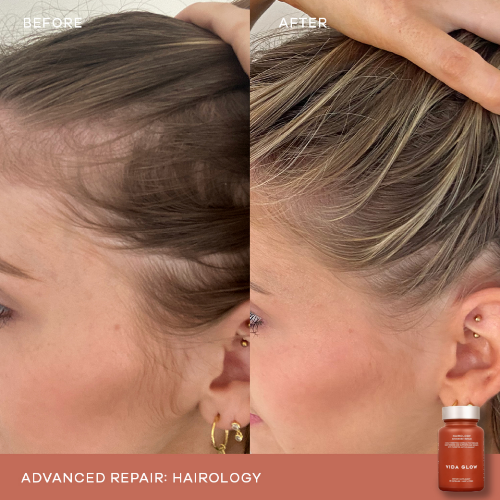 Vida Glow Hairology Advanced Repair Anagain Hair Growth Supplement 30 Capsules